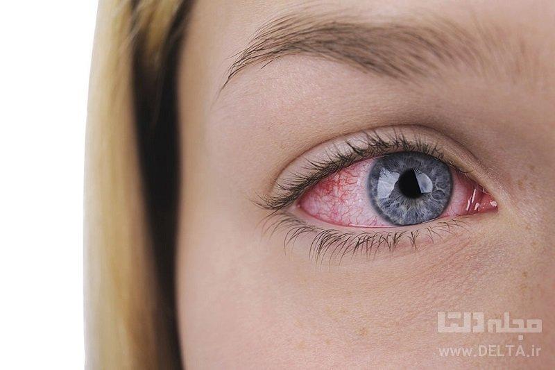 عارضه چشم صورتی، نشانه ویروس کرونا عارضه چشم صورتی، نشانه ویروس کرونا